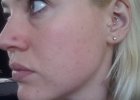 no breakouts