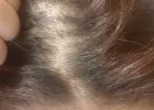 Regrowth