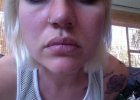 Chin area Day 21