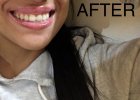 Listerine review