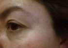 Eye - Before.jpg