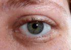 Eye Before Picture.JPG