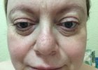 Skin Results after applying Justine 3 Step Hydrating Range.Smooth and moisterised but a little red.