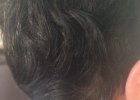 Before Treatment (greys are visible)
