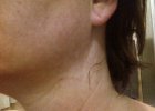 Before - Neck.jpg