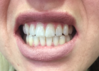 Before Using Listerine Advanced White Mouthwash