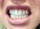 Before Using Listerine Advanced White Mouthwash