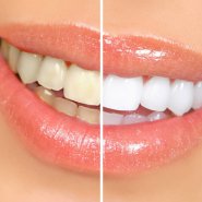 WhiteningTeeth.jpg