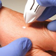 Hand Rejuvination: Laser Skin Resurfacing