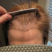 Hair Restoration