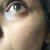 Before photo - right under eye