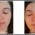 Vichy LiftActiv Serum 10 Supreme - 10 Day Results
