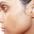 Before pics of my skin.