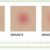 Vichy: Normaderm Hyaluspot