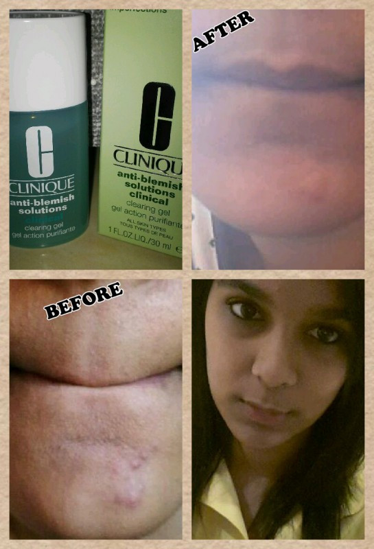 Clinique Anti Blemish Solutions