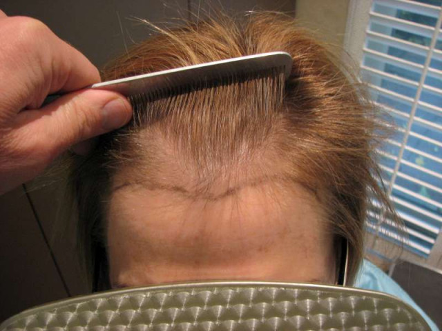 Hair Restoration