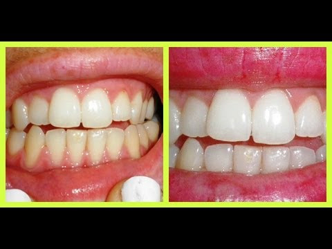 Natural DIY Teeth Whitener!